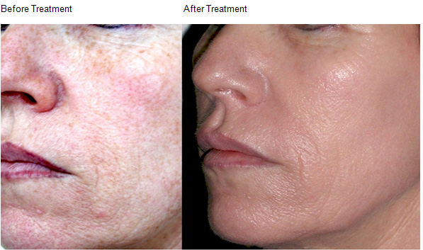 skin-peels-04