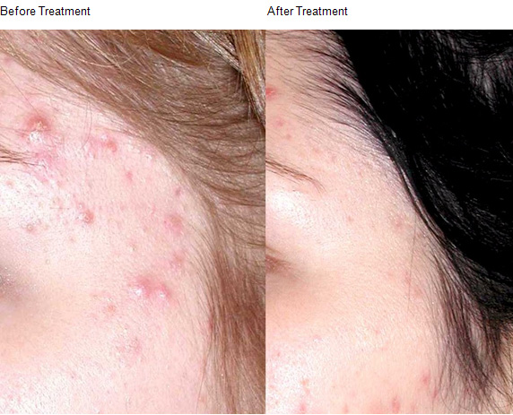 skin-peels-05