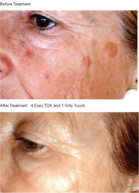 skin-peels-06